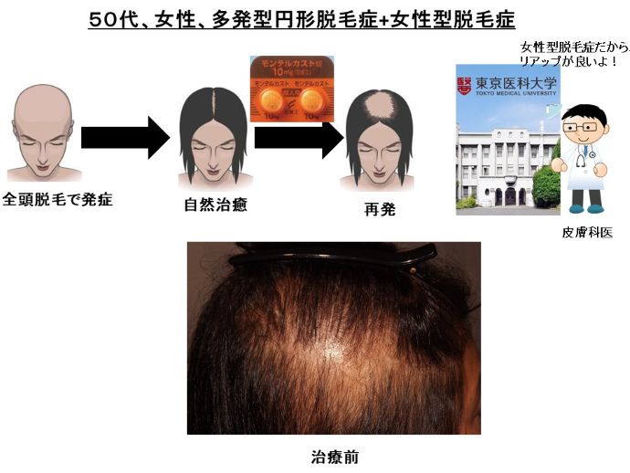 円形脱毛症　病院
